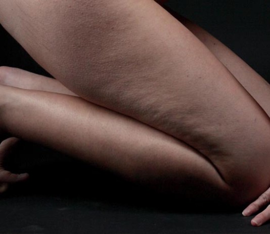 Jak se zbavit celulitidy na stehnech?